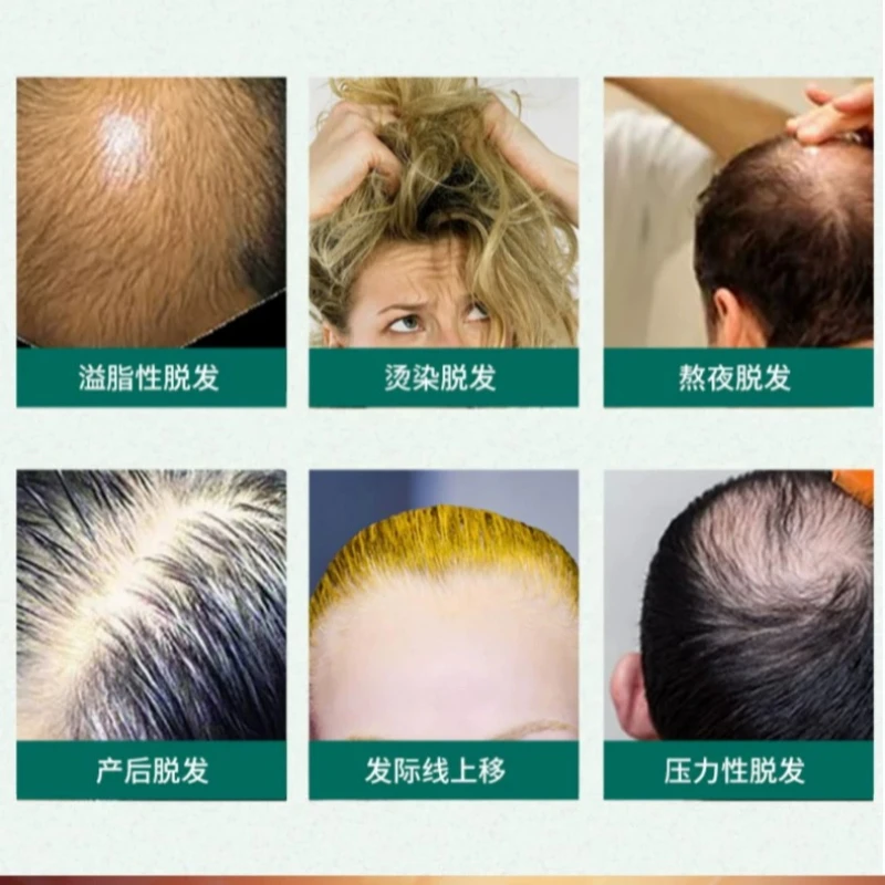 Zhangguang 101 Herbal Strengthening Shampoo 428g – Nourishes Roots & Fortifies Weak Hair, Adds Volume for Fuller, Healthier