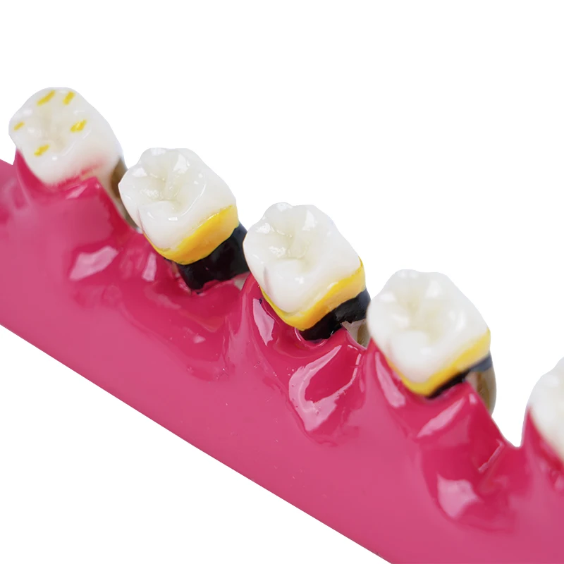 1pc Periodontal Disease Model 5-Stage Perio Disease Assort Demo Caries Periodontitis Dental Teeth Model