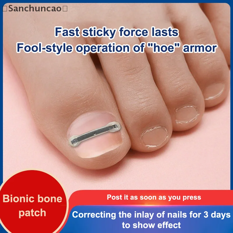 〔산〕10개입 내성발톱 치료 키트, 4가지 다양한 크기, 티타늄 합금 내성발톱 교정기, 곡선형 발톱 교정용