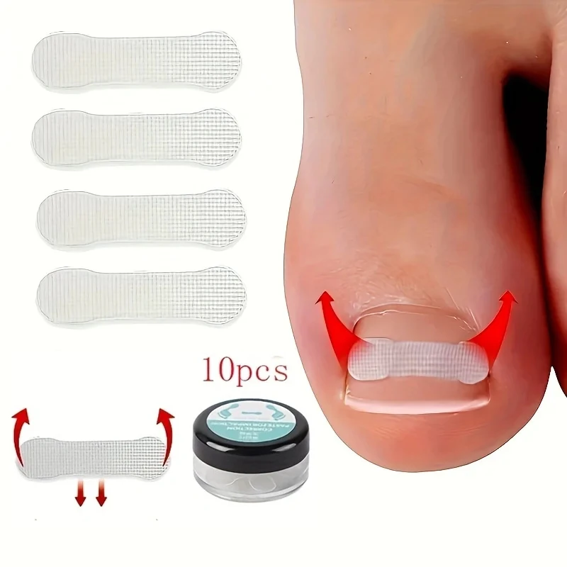 1 scatola Nail Patch Nail Groove Inlay Corrector per la riparazione rapida dell'unghia del piede striscia adesiva