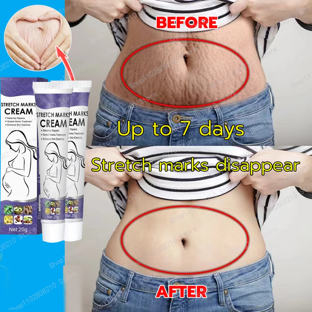 Eliminate Red White Old Stretch Marks For Pregnancy Postpartum Skin Care Gel