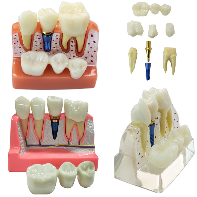 4 Times Dental Teach Implant Analysis Crown Bridge Removable Model Dental Demonstration Model Dentist Study Teaching Model