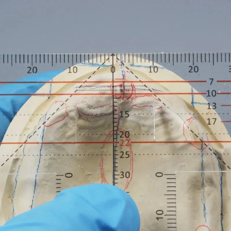 Denture Drawing And Alignment Dental Ruler T-shape Examination Orthodontic Symmetry Measurements Multifunctional