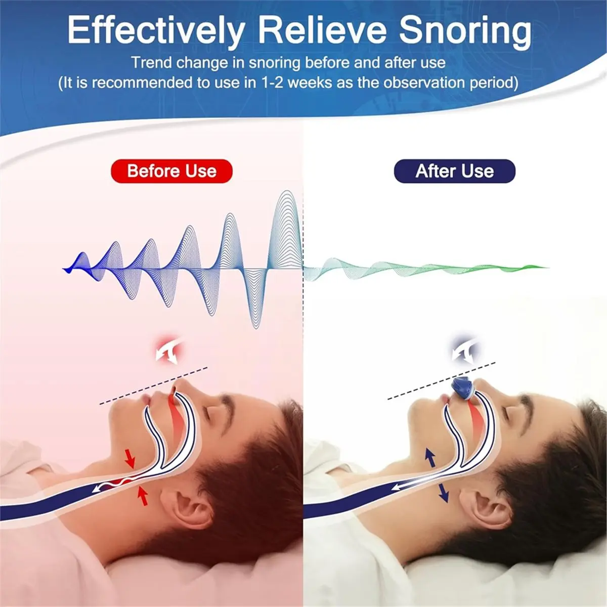 [A99U] Electric Anti Snoring Devices, Snore Reduction, Adjustable Wind Speed Nasal Dilators Snoring Solution Aids