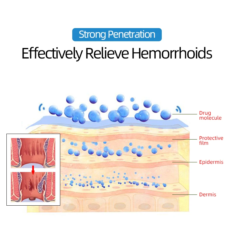 Gel de compresa fría para hemorroides, crema de eliminación de hemorroides, tapón de fisuración Anal, taburete con sangre, tratamiento de la inflamación, pilas