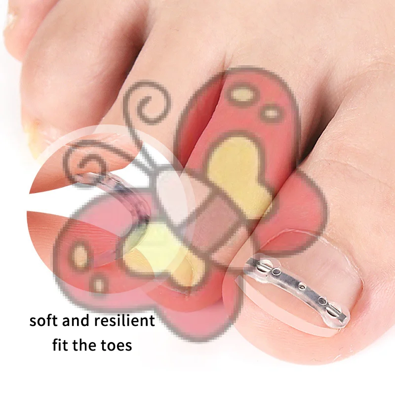2 pçs adesivos de correção de unhas elástico encravado corretor de unhas remendos adesivo auxiliar invisível tratamento paroníquia recuperar