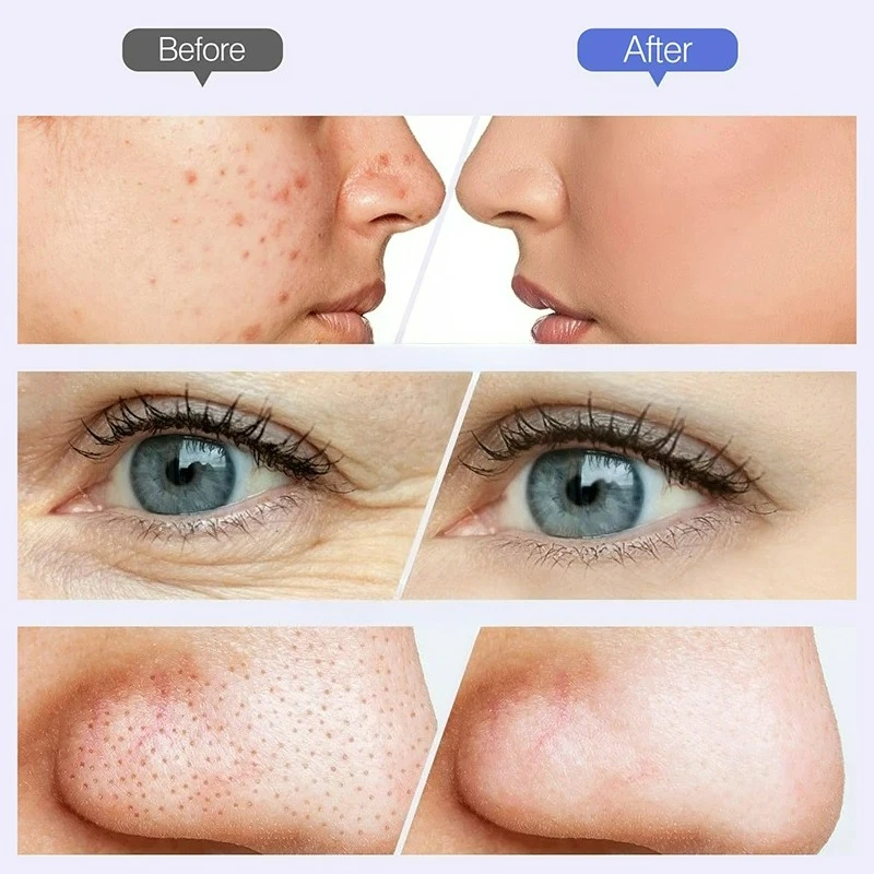 2026 Macchina per microdermoabrasione con diamante wireless Dispositivo per la rimozione di punti neri Aspirapolvere per pori Strumento per la cura della pelle del viso Dispositivo per la bellezza del viso