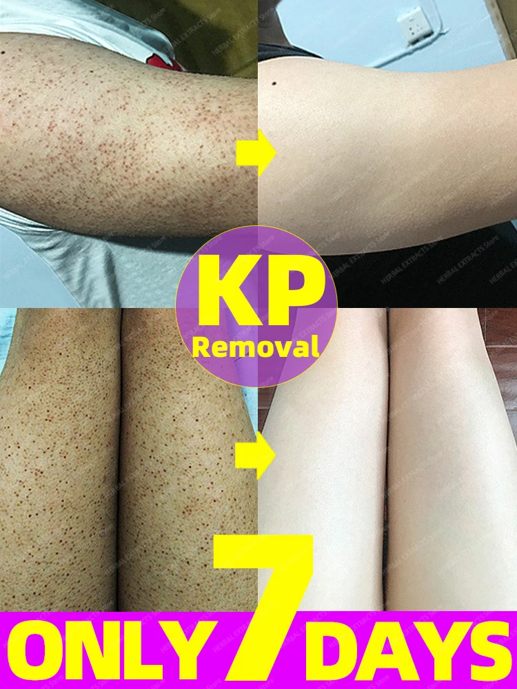 Keratosis Pilaris Treatment Cream Chicken Skin Removal Strawberry Legs Dry Skin Remover Body Scrub