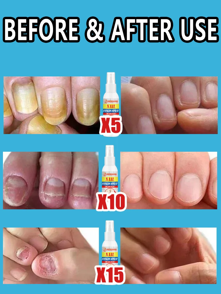Spray antimicótico para uñas: limpia las uñas dañadas y descoloridas, fácil de usar.