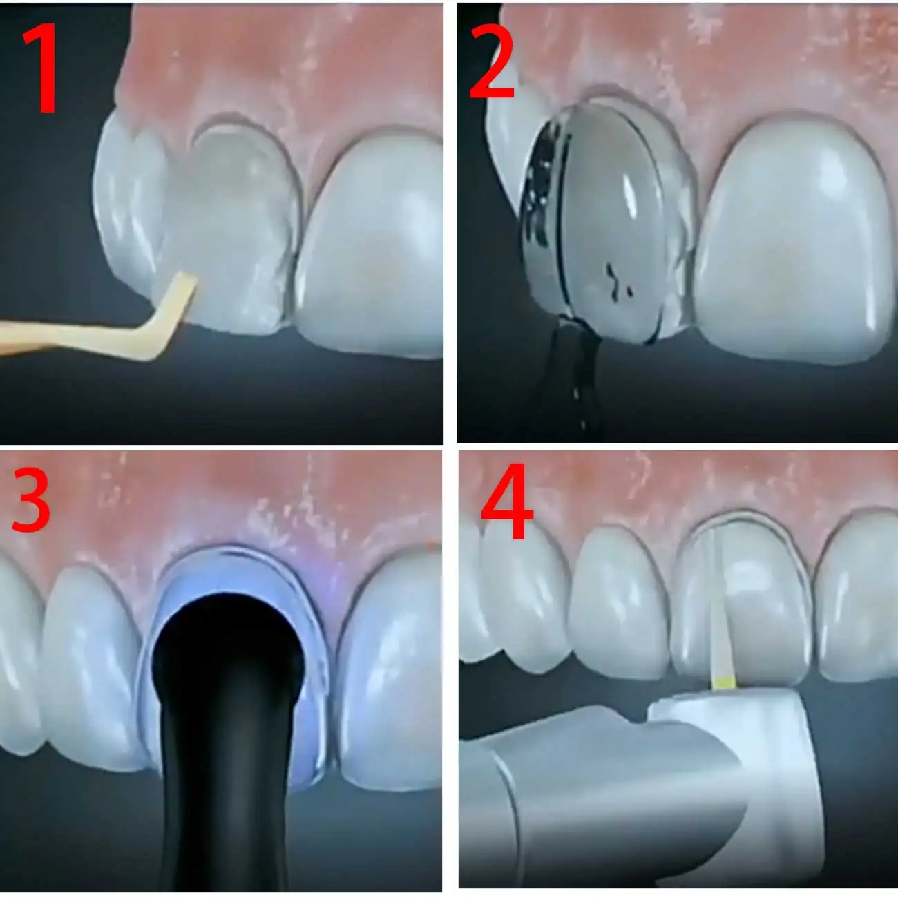 Zestaw do forniru dentystycznego forma z żywicy kompozytowej lekki autoklaw przedni przedni pleśń zębów narzędzia do wybielania zębów