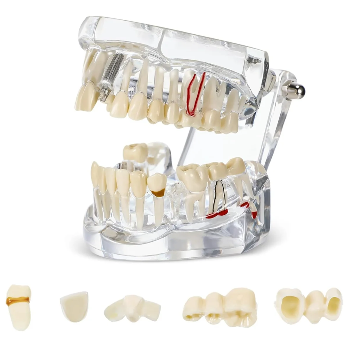 Teeth Model Disease Teeth Model Dental Typodonts Implant Teeth Model with Removable Teeth Dentist Standard Tooth Demonstration