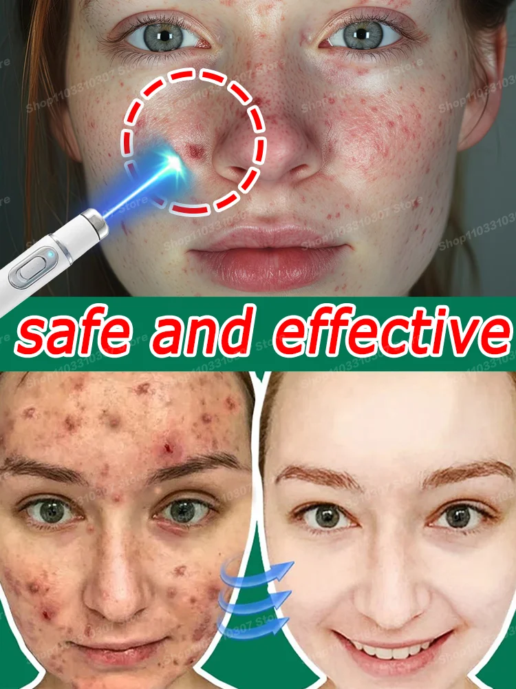 

Acne Cream Remedy Anti Pimple Marks Serum