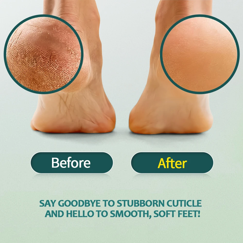 Nailpop 60ml Foot Softener Set for Quick Exfoliation Soften Calluse Dead Skin Removal Callus Softening And Foot Care Repair Tool