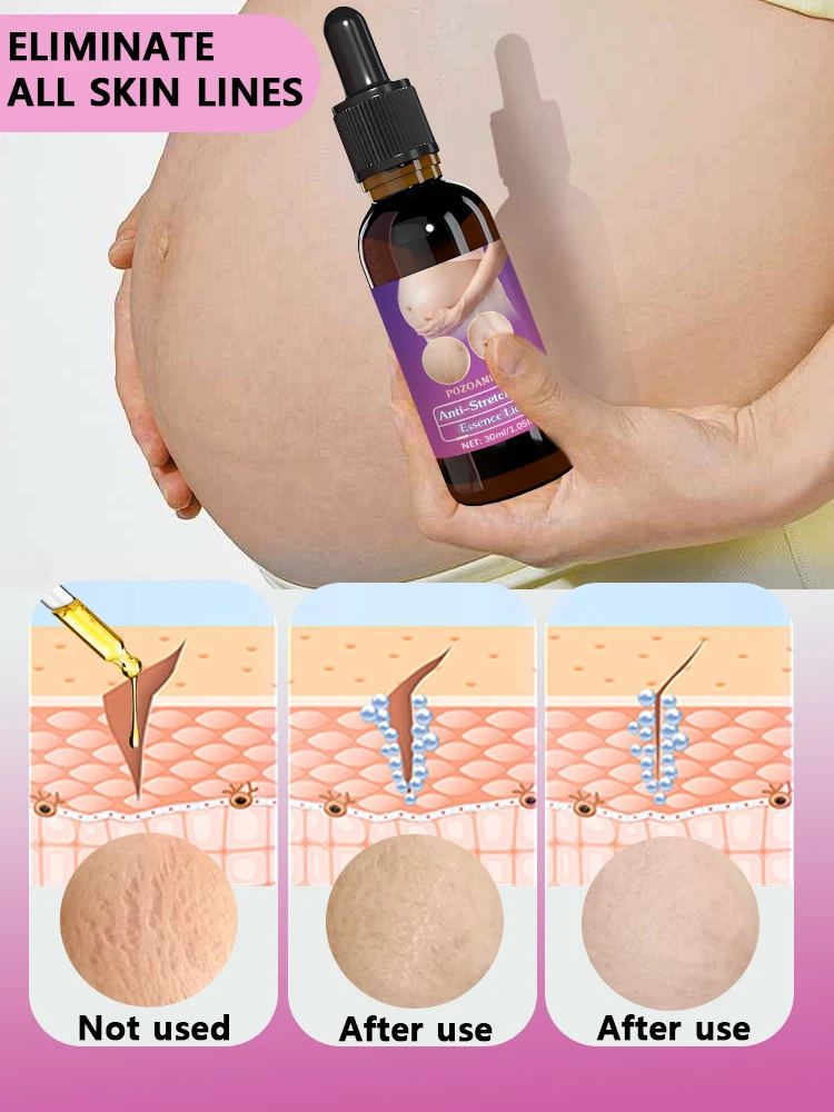 Stretch mark essential oil suitable for use during pregnancy and the postpartum period; this skincare product effectively improves skin elasticity, eliminates stretch marks, and deeply nourishes the skin.