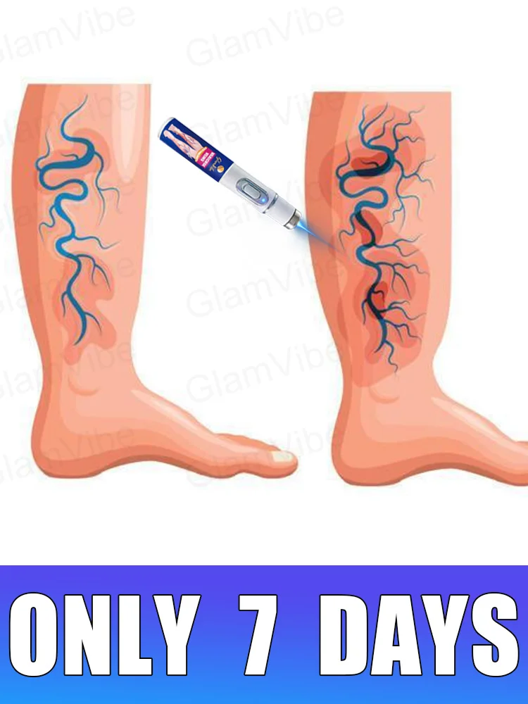 

blue light pen solve varicose veins, hot sale leg care tools