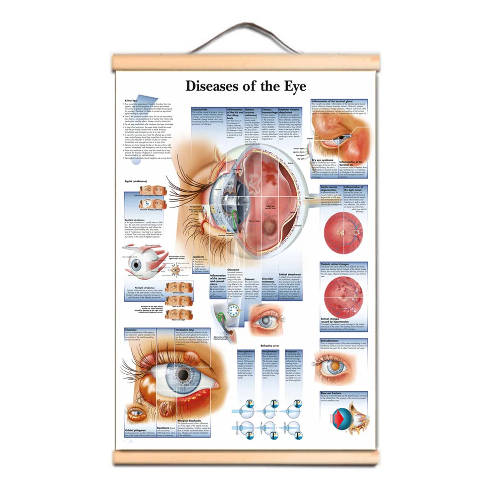 Diseases of the Eye Posters Prints Wall Chart Human Anatomy Picture Wall Art Canvas Scroll Painting Hospitals Clinics Home Decor
