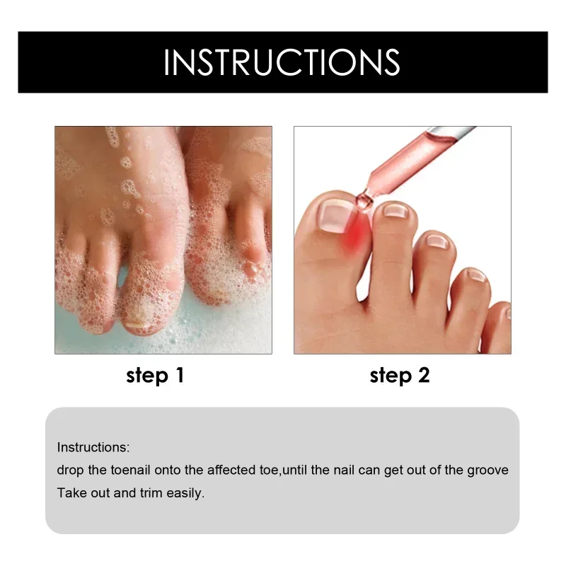 7 Day Nail Fungal Treatment Serum Foot Toe Nail Fungus Removal Essential Oil Anti Infection Onychomycosis Paronychia Repair Gel