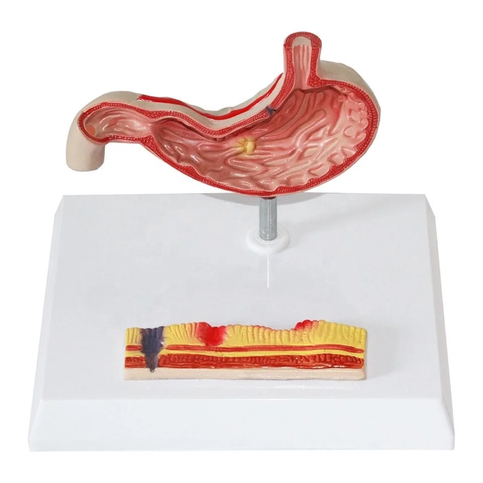 Medical Science Human Pathology Stomach Anatomy Model Human Anatomical Organ Disease Model