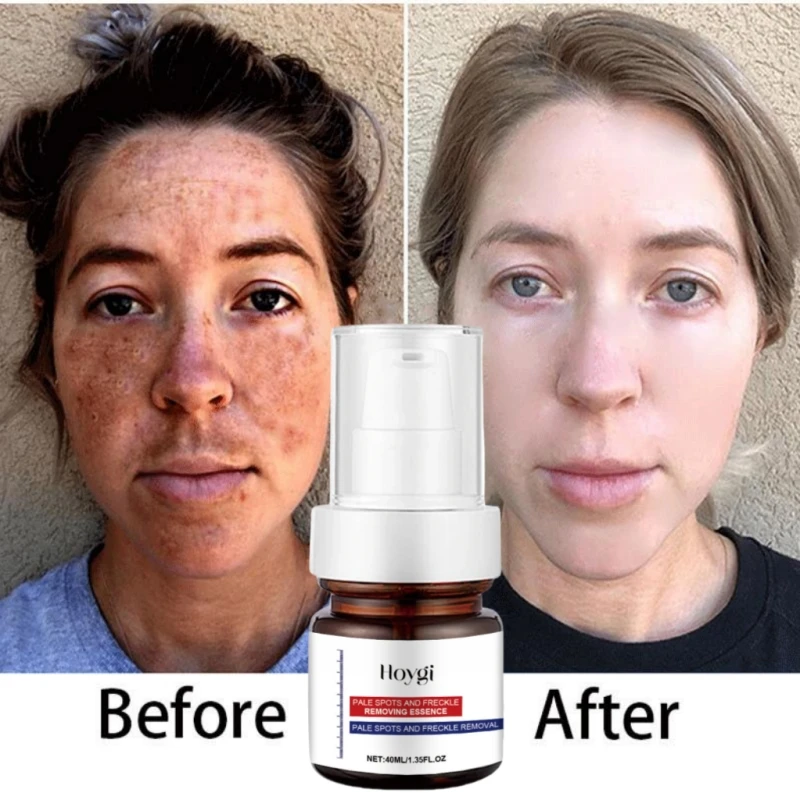 Powerful Spot-removing Whiten Serum Cream Vitamin C Skin Brighten Essence Removal Melasma Dark Spots Moisturize Beauty Skin Care