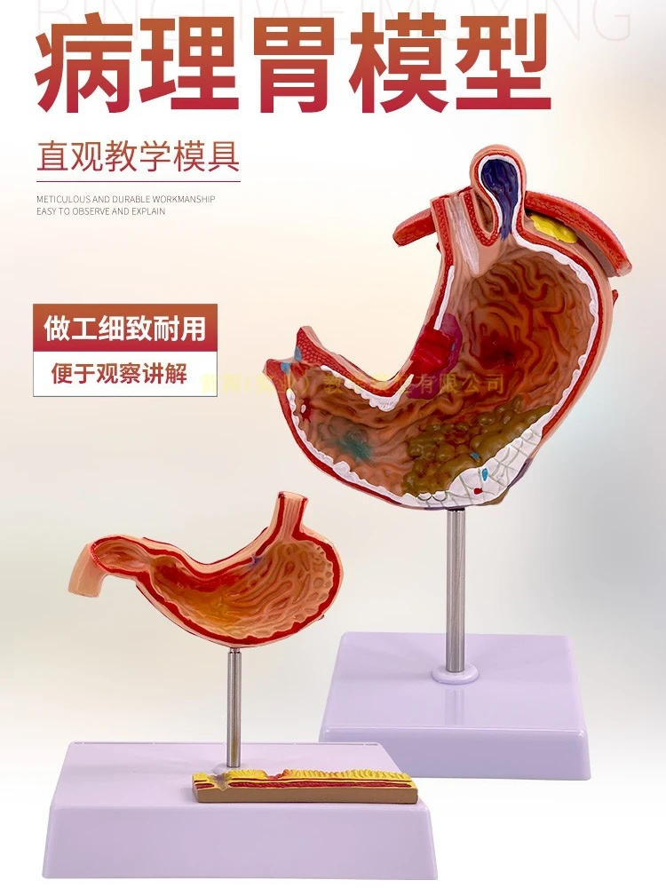 Gastric anatomical model Pathological disease demonstrationPathological Human