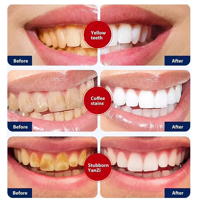 Fast Remove Smoke Stains Toothpaste Remove Plaque Stain Bad Breath Dental Calculus Oral Hygiene Clean Fresh Breath Dental Tools