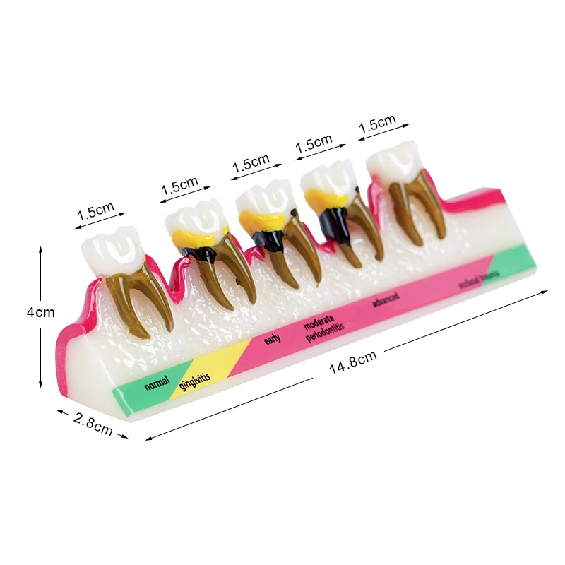 Teeth Periodontal Disease Model Resins Pathological Model 5-Stage Evolutionary for Doctor-Patient Communication