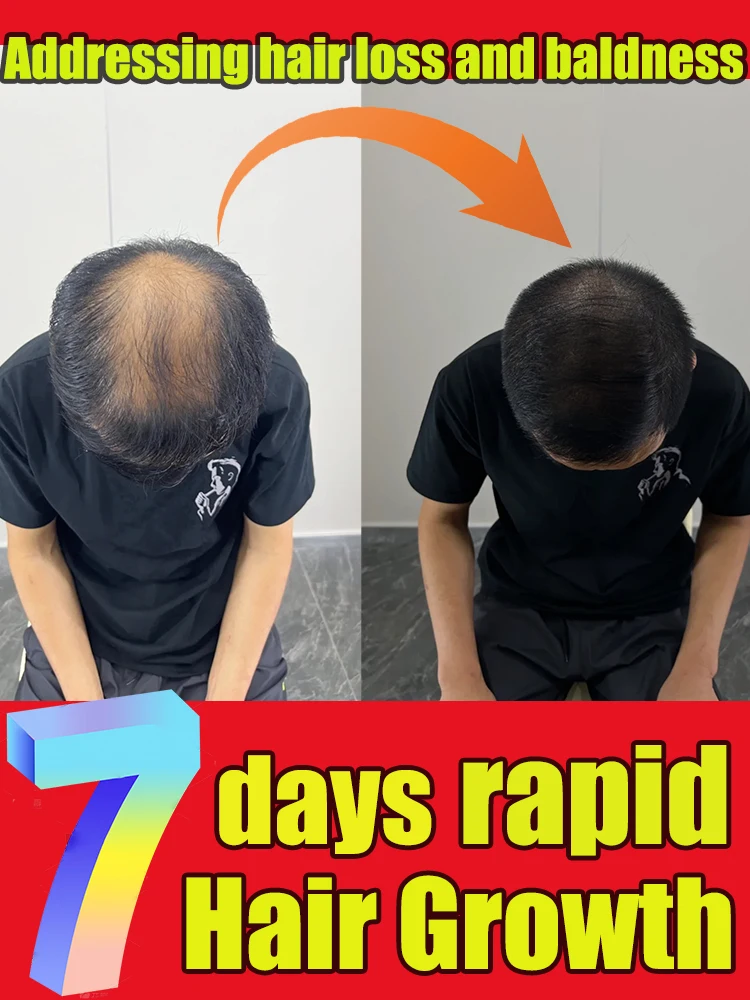 

Hᴀɪʀ ɢʀᴏᴡᴛʜ ᴀɢᴇɴᴛ, ғᴀsᴛ ɢʀᴏᴡᴛʜ, ʜᴀɪʀ ʀᴇɢᴇɴᴇʀᴀᴛɪᴏɴ, ʜᴀɪʀ ғᴏʟʟɪᴄʟᴇ ɴᴏᴜʀɪsʜɪɴɢ ᴇssᴇɴᴄᴇ, ᴀᴠᴀɪʟᴀʙʟᴇ ғᴏʀ ᴍᴇɴ ᴀɴᴅ ᴡᴏᴍᴇɴ