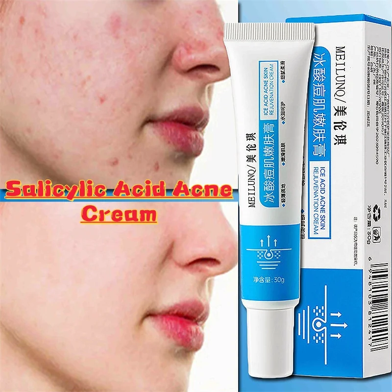 

Salicylic Acid Acne Removal Cream Anti-Acne Repair Redness Pimple Spots Deep Cleaning Pore Oil Control Moisturizing Skin Care