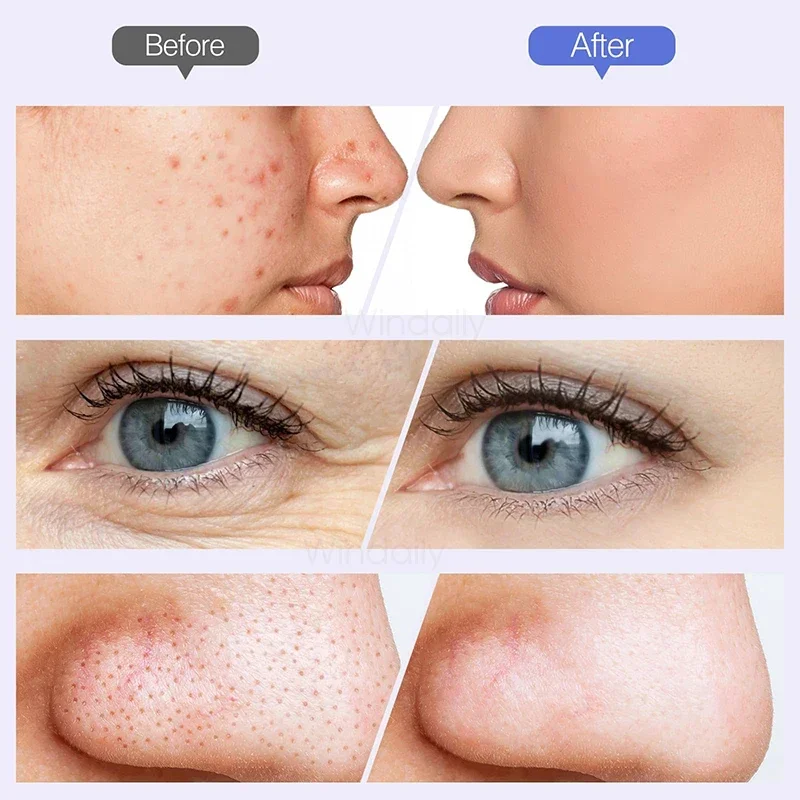 2025 sem fio diamante microdermoabrasão máquina removedor de cravo vácuo poros limpador facial ferramenta cuidados com a pele rosto dispositivo beleza
