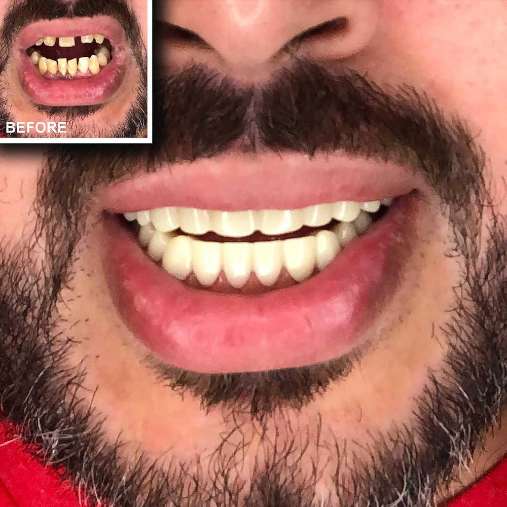 Thumbnail 4 - #23 Latest Denture Adhesives Updates