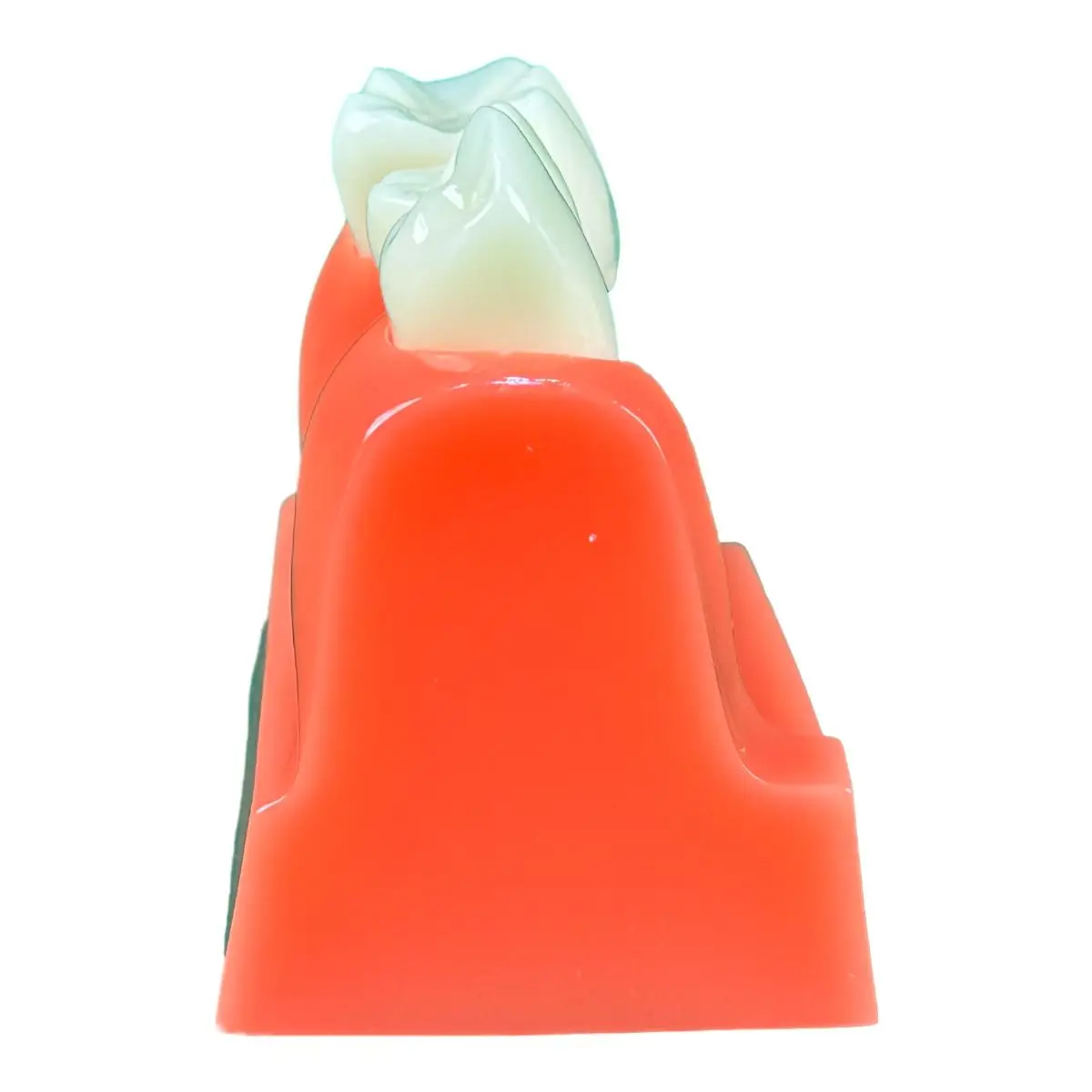 4X Implant Interpretation Model, Oral Dental Model, Crown Removable Implant Nail Display Model, Doctor-patient Communication