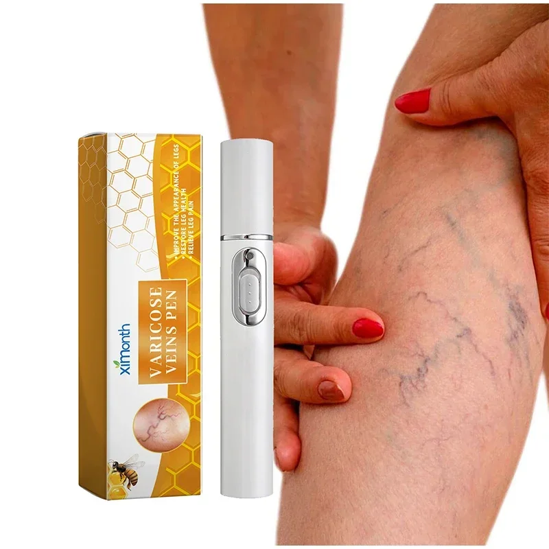 Thérapie au laser pour le traitement des varices, stylo à lumière bleue efficace pour les jambes de Charleroi, la vascularite dilatée, la phlébite,