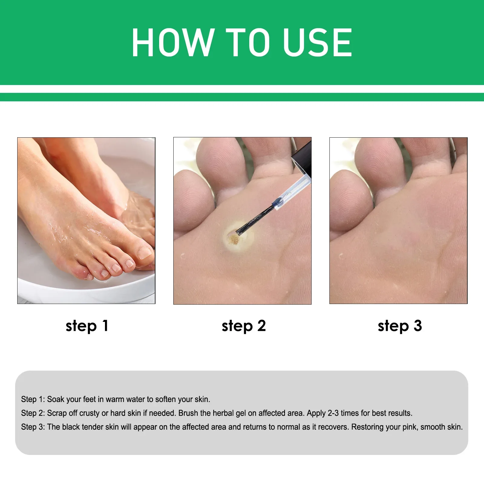 Foot Corn Removal Cream Chicken Eye Skin Infection Treatment Chicken Eye Solution Foot Dead Skin Scab Removal Tool Health발톱무좀