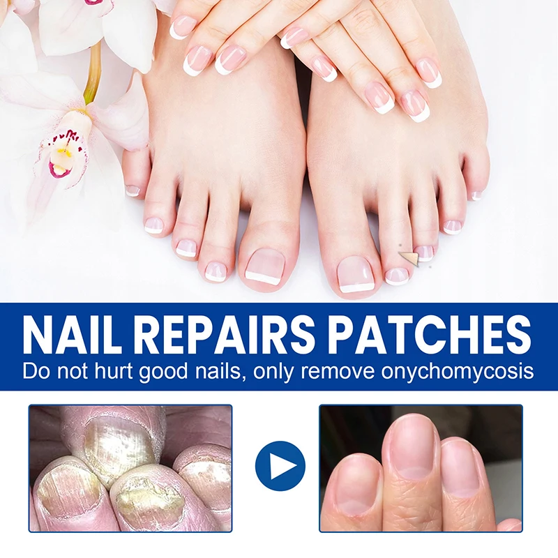 60Pcs Toenail Fungus Patch Sticky Nail Repair Patch Nail Ingrown Correction Sticker Toenail Care Paronychia Nail Treatment Patch