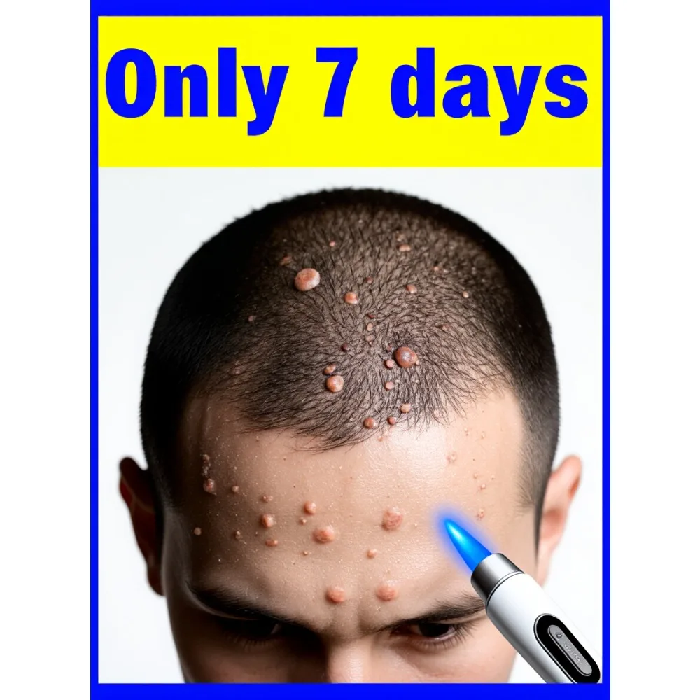 

Blue light wart removal pen, solve your troubles in 7 days,hot sale wart care tools