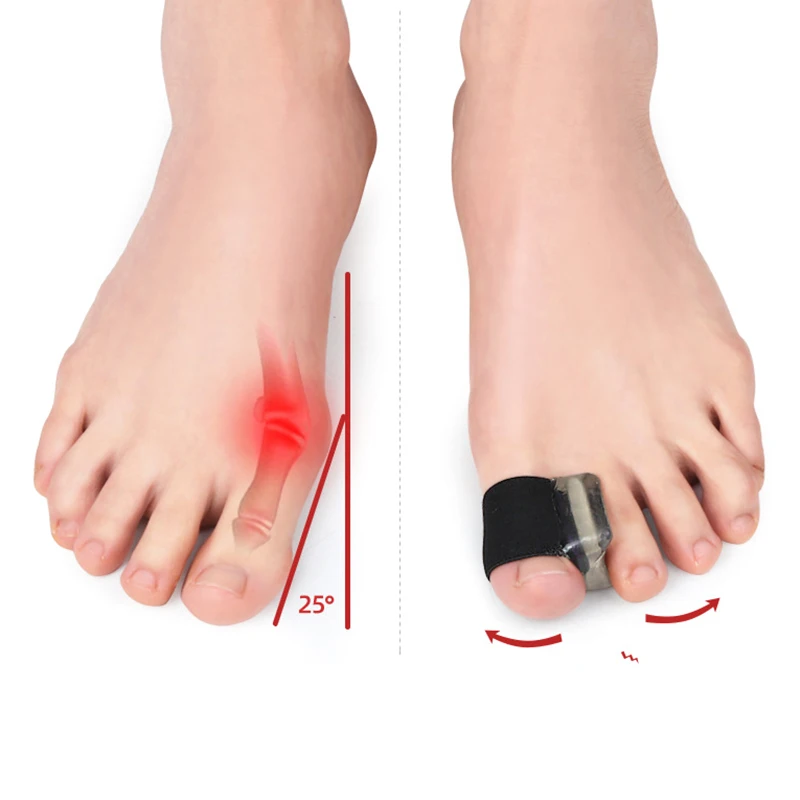 Plantillas separadoras de dedos de los pies, almohadillas correctoras de Hallux Valgus, cuidado ortopédico, 2 piezas