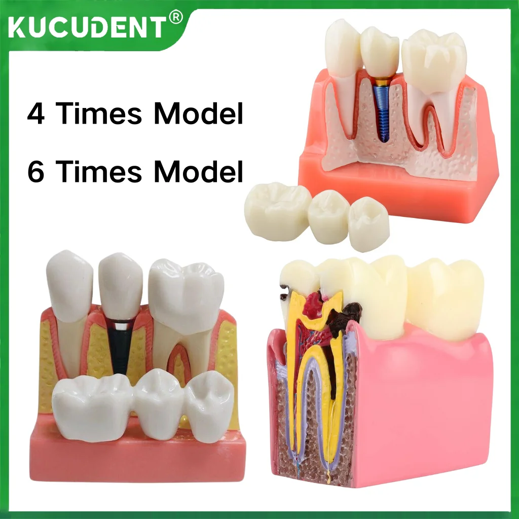4/6 Times Dental Implant Teeth Model Caries Tooth Model  Analysis Crown Bridge Demonstration Removable Training Teaching Models