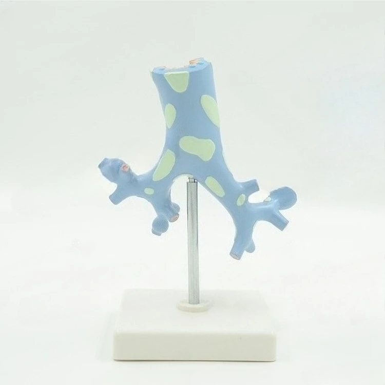 Anatomical model of lung bronchial tree in pathology of human respiratory system