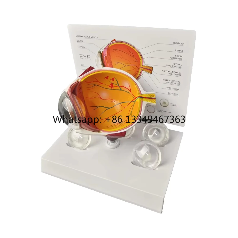 

Модель глаза с катарактой (4 шт.): различные виды катаракты, для обучения анатомии и демонстрации пациентам