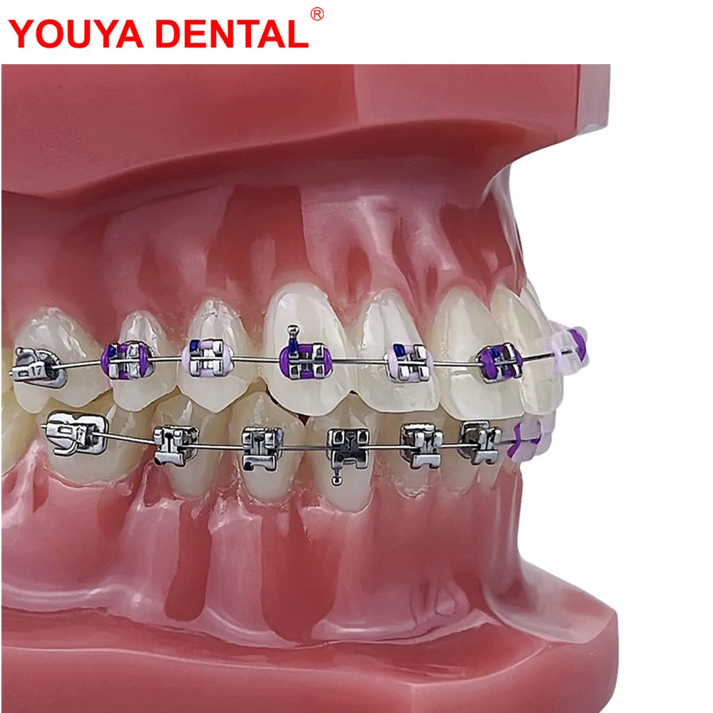 New Dental Orthodontic Teeth Model With Braces Bracket Dentistry Treatment Orthodontic Dental Model For Teaching Educatiion Demo