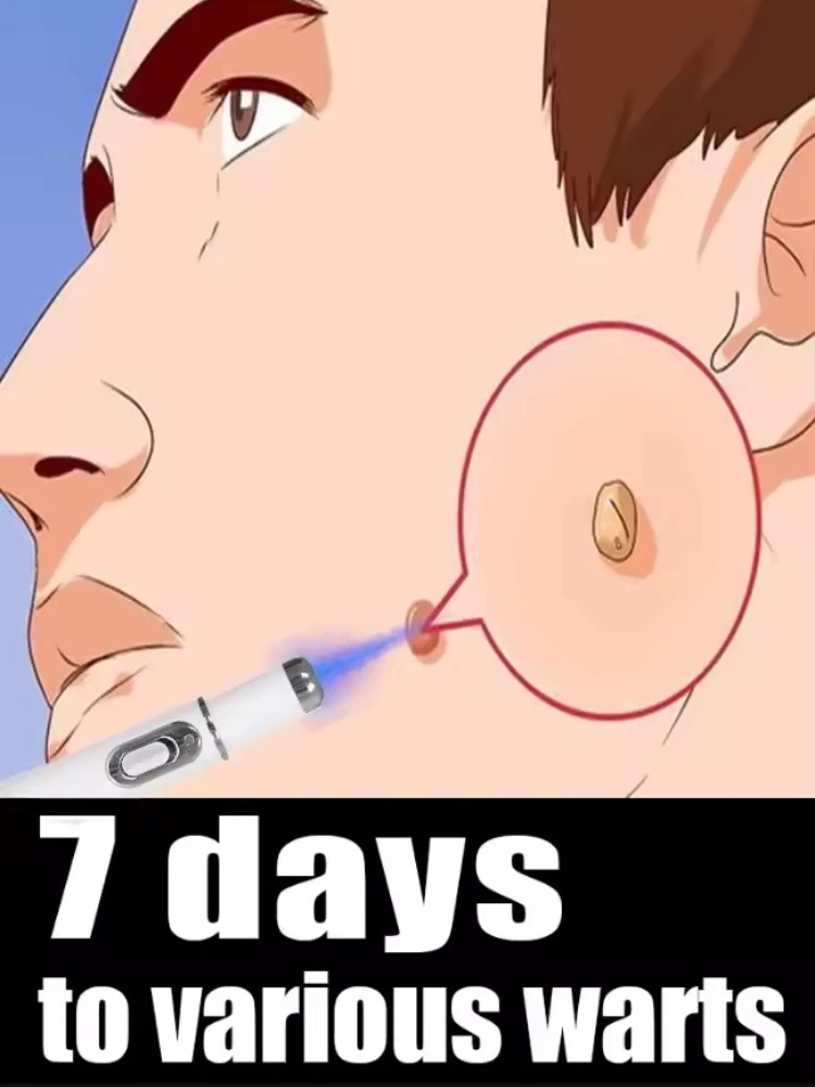 

Ручка синего света для решения бородавок, горячая распродажа, инструменты для ухода за бородавками