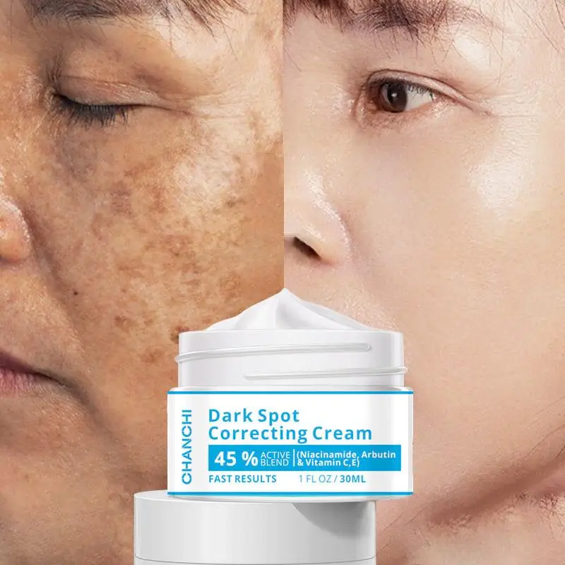 Whitening Freckles Cream Remove Melasma Dark Spot Lightening Melanin Brightening Melasma Remover Moisturize Anti-aging Face Care