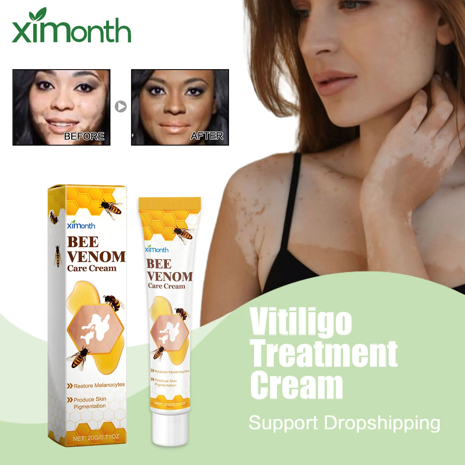 Bee Venom Vitiligo Treatment Cream Anti Dry Itchy Skin White Spot Remover Adjust Melanin Prevent Spread Leukoderma Care Ointment