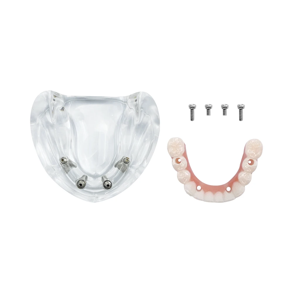 Dental Implant Teeth Model With 4 Removable Screws Transparent Upper/Lower Dental Overdenture Teeth Model  For Education Studyin