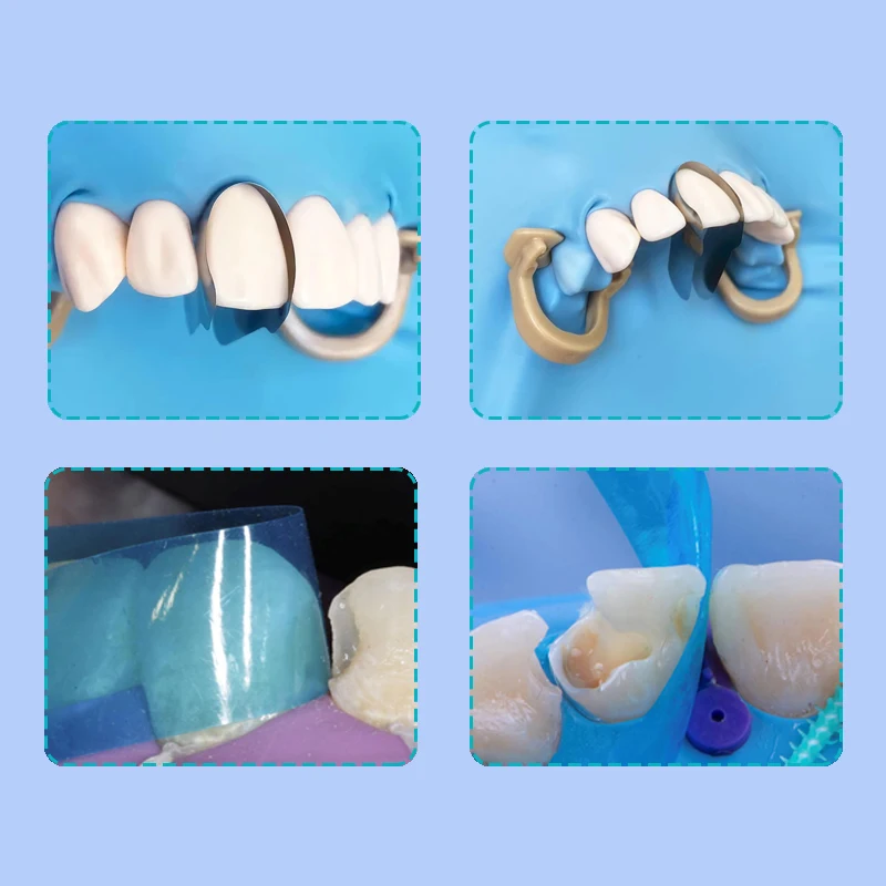 Matriz anterior contornada dental, Bandas Matrix Metálicas, Restauração de Resina, Faixa Azul, Materiais Dentistas Gêmeos