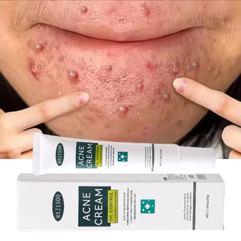 

Herbal Acne Removal Face Cream Pimples Scar Repair Gel Oil Control Shrink Pore Whitening Moisturizing Skin Care Korean Cosmetics