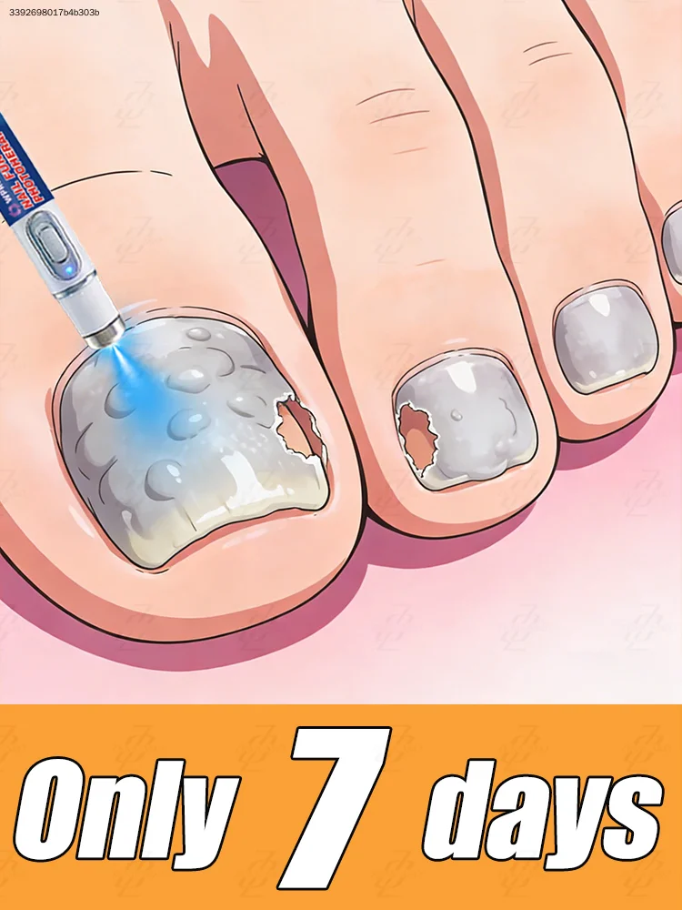 

Горячая новинка 2026 года: Лазерное средство для лечения грибка ногтей (онихомикоза). Только за 7 дней, без повторов.