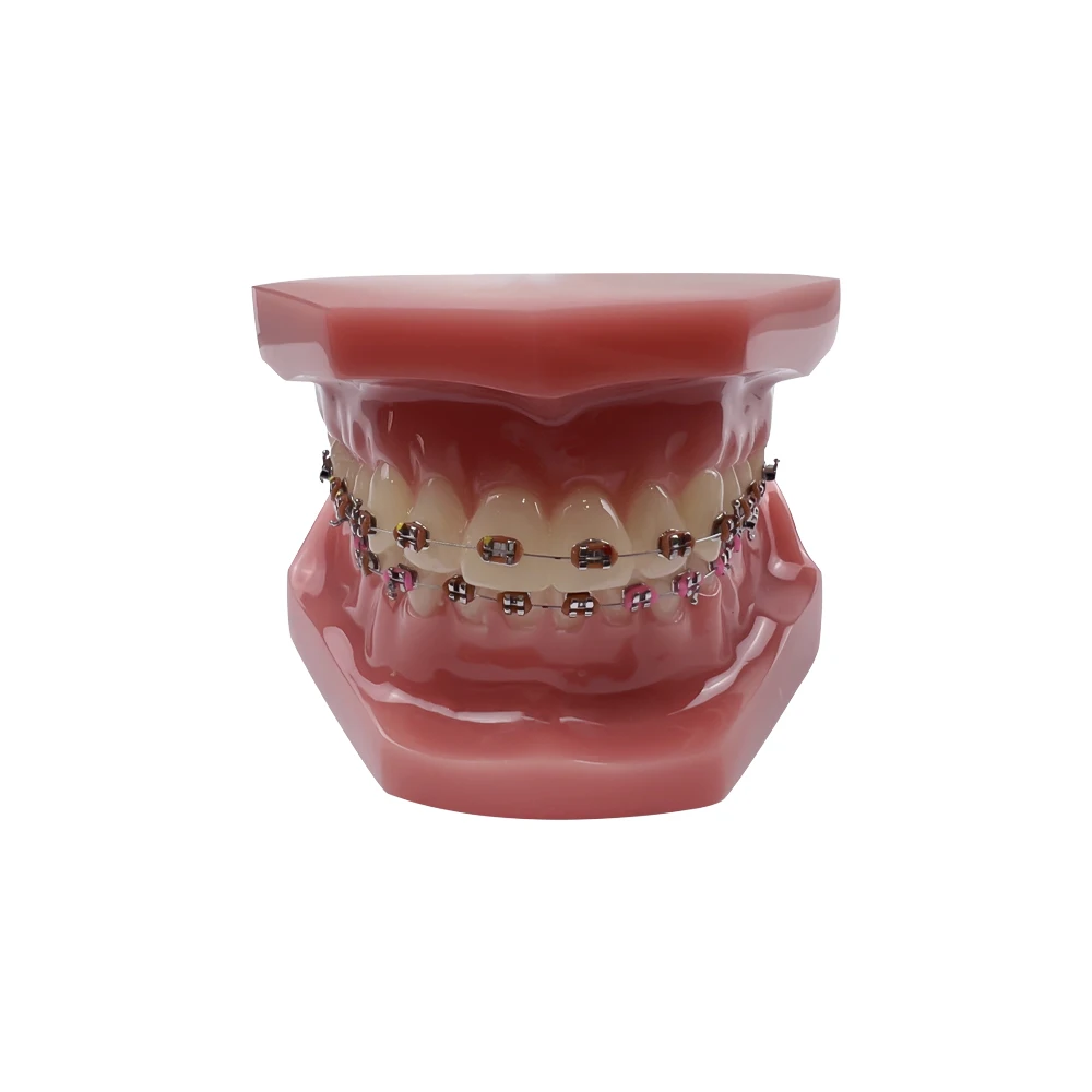 Orthodontic Treatment Model with Full Ortho Metal Wire with Buccal Tube Ligature Ties Standard Model Dentistry Communication