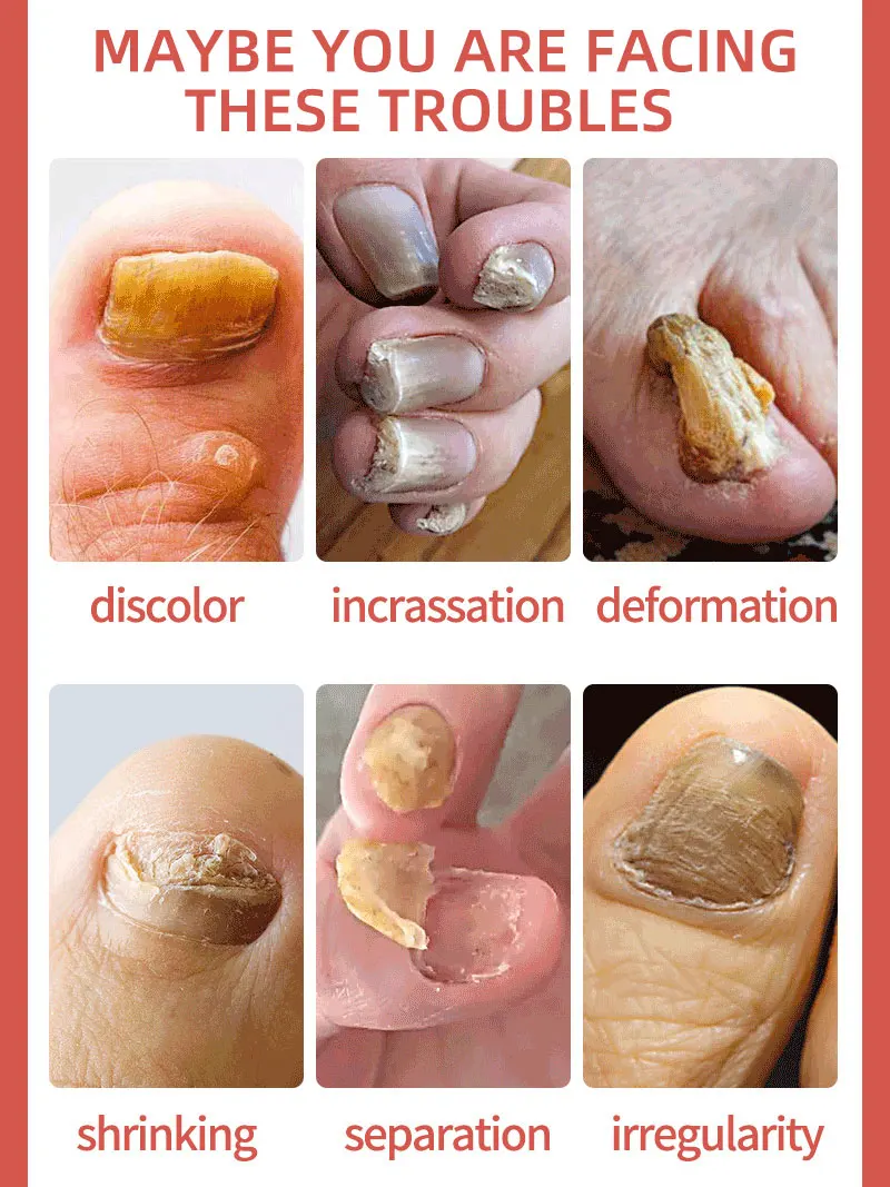 Nail Fungus Reducing