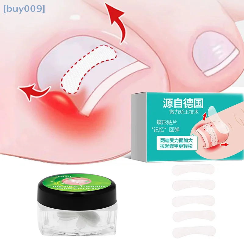 10 Stuks Ingegroeide Teennagel Correctie Tool Rechttrekken Clip Brace Ingegroeide Teen Nagel Behandeling Elastische Patch Sticker Pedicure Tool